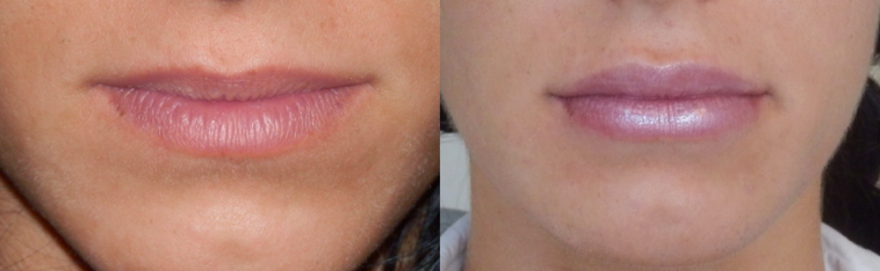 lips before and after treatment